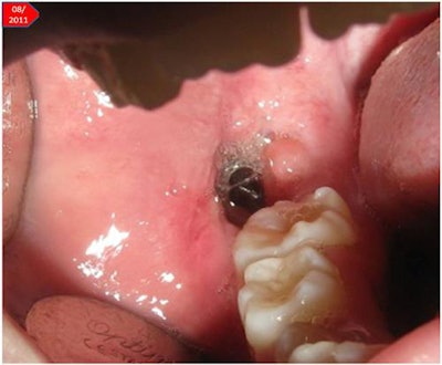An intraoral view of an ameloblastoma in the right mandible of an 11-year-old girl. All images courtesy of Bonitz et al. Licensed under CC BY-NC-ND 4.0.
