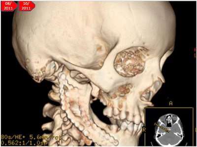 A CT scan of the girl's jaw two months after surgery.