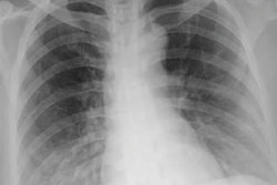 2021 07 14 23 16 8075 2021 07 16 Ai Cxr Blood Test Covid Prediction 400 20210714234829