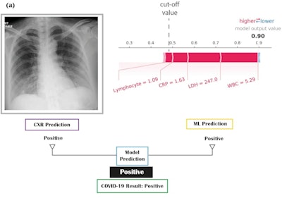 If the Shapley additive explanations (SHAP) output value was above 0.48, then the blood test prediction was positive. The relative contribution of each laboratory marker is shown in the individual SHAP value plot. (a) An elderly female with a positive prediction from chest x-ray (bilateral lower zones shadowing) and positive prediction from laboratory markers. The ground-truth COVID-19 RT-PCR result was positive.