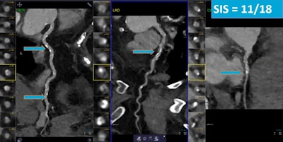 A 56-year-old patient with a clinical history of hypertension, diabetes, and dyslipidemia. Cardiac CT angiography showed obstructive stenosis. The segment involvement score was 11. Image courtesy of Dr. Ahmed Ibrahim Ahmed.