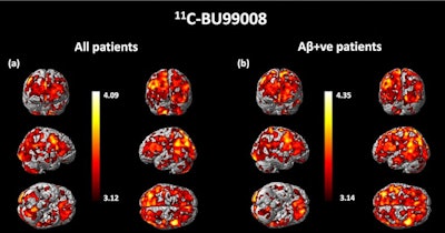 Statistical parametric mapping analysis of significantly increased C-11 BU99008 uptake as a group for (a) all cognitively impaired (CI) subjects and (b) beta amyloid-positive CI subjects compared with healthy controls, using a cluster threshold of p < 0.05 and with extent threshold of 50 voxels. The color bar indicates the Z-score. Image courtesy of Molecular Psychiatry.