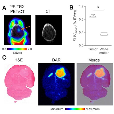(A) F-18 TRX PET/CT data showing radiotracer uptake in a U87 MG tumor (arrow) implanted within the right hemisphere of a mouse brain. The image was acquired at 90 minutes post injection. (B) Quantification of F-18 TRX uptake using ROI analysis of the PET data from mice bearing U87 MG tumors (n = 3). The tumor uptake was compared to uninvolved normal white matter on the contralateral region of the brain. (C) Digital autoradiography showing the distribution of the radiotracer within a coronal section of the mouse brain. The tissue was stained with H&E and merged with the pseudocolor image of the autoradiography. Image courtesy of the Journal of Nuclear Medicine