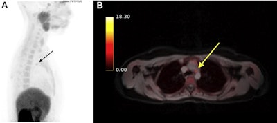 FCH-PET image of an ectopic mediastinal parathyroid adenoma (arrows) on (A) sagittal and (B) axial view fused with simultaneous MRI. This patient had previously undergone a bilateral neck exploration, which had failed to localize a left lower gland. Ultrasound, sestamibi, and 4D CT were all negative. After FCH-PET localization, a robot-assisted left thoracoscopic approach was employed to resect the gland from the aortopulmonary window. Follow-up blood work 8 months after surgery confirmed normalization of calcium. Image courtesy of Surgery.