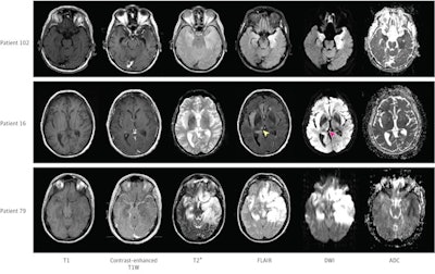 Patient 102 had bilateral but asymmetrical hyperintensities in the temporal lobes seen on fluid-attenuated inversion recovery (FLAIR) images and diffusion-weighted imaging (DWI) magnetic resonance imaging sequences. Patient 16 had right thalamic hypersignal on FLAIR and DWI sequences (arrowheads), ipsilateral to the insular lesion. Patient 79 had extensive brain lesions, showing bilateral temporal, frontal, and insular signal abnormalities. ADC indicates apparent diffusion coefficient; T1W, T1-weighted. Image and caption courtesy of JAMA Network Open.