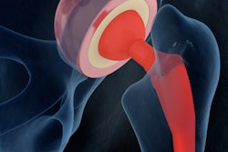 2018 04 20 16 25 5095 Hip Joint 3 D 400