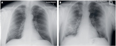 (A) April 10, a 53-year-old man, the fourth day after the onset of symptoms (cough, fever, oxygen saturation 97%); chest x-ray: unilateral, focal, peripheral patchy consolidation -- ground-glass opacity in the right lung; five-point scale score: 3. (B) April 17, chest x-ray: peripheral multifocal diffuse patchy consolidations in the right and left lung; five-point scale score: 4. Image and caption courtesy of Advances in Clinical and Experimental Medicine.
