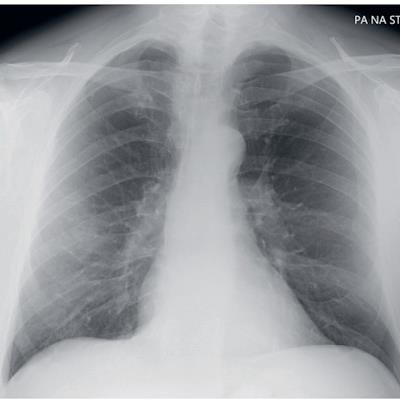 lung cancer stage 2 xray