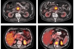 2021 08 06 23 11 2707 2021 08 09 Fdg Uptake Pancreatic Cancer 400