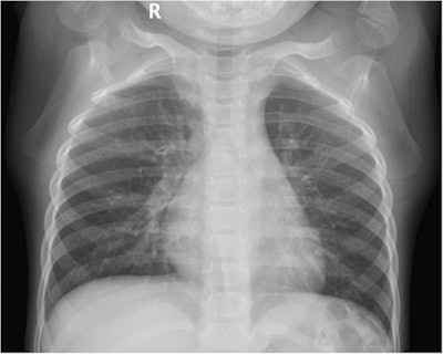 Digital chest x-ray of a pediatric participant in the supine anterior-posterior projection group. The image shown is that of a 38-month-old female with a height of 109 cm, a weight of 15 kg, and a body mass index (BMI) of 12.63 kg/m2. The ESD value was 0.07 mGy and the DAP value was 0.22 dGy*cm2.