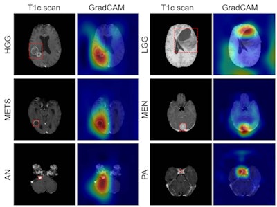 Figure shows coarse attention maps generated using gradient-weighted class activation mapping (GradCAM) for correctly classified high-grade glioma (HGG), low-grade glioma (LGG), brain metastases (METS), meningioma (MEN), acoustic neuroma (AN), and pituitary adenoma (PA). For each pair, the postcontrast T1-weighted sca, and the GradCAM attention map (overlaid on scan) have been shown. In GradCAM maps, warmer and colder colors represent high and low contribution of pixels toward a correct prediction, respectively. Image and caption courtesy of RSNA.