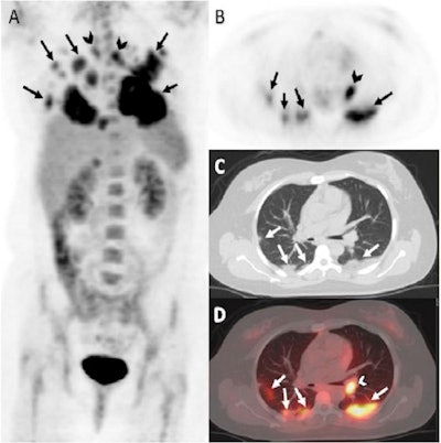 A 60-year-old woman with metastatic lung cancer who underwent FDG-PET/CT for radiation therapy planning. The patient reported muscle aches and headache and had a positive COVID-19 RT-PCR test on the same day of the PET/CT. FDG-PET maximum intensity projection (MIP) image (A) and axial PET, CT, and fusion PET/CT images (B-D) demonstrated newly detected FDG-avid bilateral opacities and consolidation, predominantly subpleural in location (arrows). The hottest opacity was in the left lower lobe with SUVmax of 11.5. FDG-avid hilar lymph nodes are also identified (arrowheads), with SUVmax of 6.2. Image courtesy of Clinical Imaging.