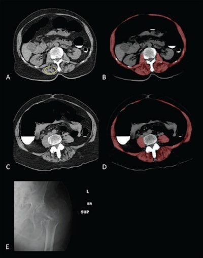 Sarcopenia (myosteatosis) at screening CT colonography in a 79-year-old woman with subsequent hip fracture. Image at L1 vertebral level without (A) and with (B) overlay of automated skeletal muscle segmentation (B, red). Intramuscular fat is present within paraspinal muscles (A, yellow circle). Mean muscle attenuation is similar for manually placed ROI (1.8 Hounsfield units [HU]) and automated tool (3.9 HU), being markedly decreased for both approaches. Muscle cross-sectional area is relatively preserved when intramuscular fat is included. CT images at L3 level without (C) and with (D) muscle segmentation demonstrate similar findings. E. Hip radiograph demonstrates left intertrochanteric femoral fracture that occurred when the patient fell two years later. The patient died four years after falling. Images courtesy of the American Journal of Roentgenology.