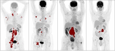 Maximum intensity projections of patients with high metabolic tumor volume (MTV), low MTV, high dissemination, and low dissemination. Tumor delineations are indicated in red. From left: high MTV and high dissemination, low MTV and high dissemination, high MTV and low dissemination, and low MTV and low dissemination. Image courtesy of the European Journal of Nuclear Medicine and Molecular Imaging.