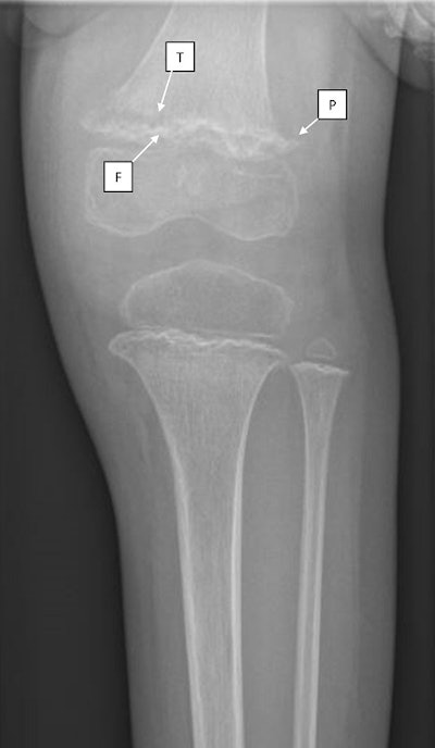 Radiograph of the patient's left knee showing dense zones of provisional calcification (F: Fraenkel line) with underlying lucent metaphyseal bands (T: Trummerfeld zone). Also identified is spurring at the distal femur and proximal tibia (P: Pelkan spurs) and a displaced fracture of distal femoral metaphysis. Image courtesy of the Journal of Imaging in Emergency Medicine.