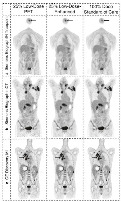 Example 25% low-count PET images, the 25% low-count-enhanced images, and the corresponding standard images for all three scanners for subjects with body mass index (BMI) under 30. (A) A 66-year-old male with BMI of 27 scanned on a Siemens Biograph 64 TruePoint for oropharyngeal cancer (solid arrow pointing to a distant lung metastasis). (B) A 34-year-old female with BMI of 20 scanned on a Siemens Biograph mCT for lymphoma (solid arrow pointing to metastatic lymph nodes and dashed arrow pointing to lesion in the spleen). (C) A 58-year-old male with BMI of 23 scanned on a GE Discovery MI with lung cancer (solid arrow). For all subjects, all low-count images appear considerably noisier compared with the low-count-enhanced and standard images. Note: SUV display scale is 0-7. Image courtesy of npj Digital Medicine.