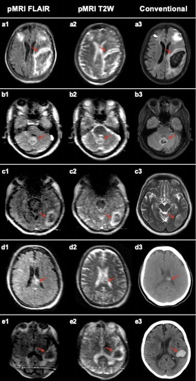 Intracerebral hemorrhage at 0.064-tesla versus conventional imaging modalities (CT or 3-tesla MRI). The first and second columns are low-field FLAIR and T2W images, respectively. The third column is a gold-standard clinical examination for comparison (3-tesla MRI: A3, B3, C3, and E3; CT: D3). (A) Left isointense frontoparietal intracerebral hemorrhage (ICH) with hyperintense rim and bilateral frontal hematomas. (B) Bilateral isointense cerebellar ICH with hyperintense rim. (C) Left hypointense occipital lobe ICH with hyperintense rim. (D) Left homogenous, hyperintense ICH in corpus callosum. (E) Left hypointense temporal ICH with hyperintense rim. Images and caption courtesy of Mazurek, M.H., Cahn, B.A., Yuen, M.M., et al. and Nature Communications through Creative Commons Attribution 4.0 International License.