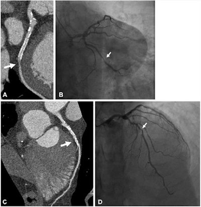 Example of a 61-year-old man with a history of myocardial infarction who was found at UHR-CT to have a severe (≥ 70%) stenosis in a large obtuse marginal branch of the left circumflex artery just distal to (A) a patent stent, which was confirmed at (B) invasive angiography. In addition, there was moderate disease noted by (C) ultrahigh-resolution CT in the left main and in the middle left anterior descending artery (50%-70% stenosis), which was underestimated compared with (D) invasive angiography (70% stenosis). Arrow points to corresponding stenoses. Images and caption courtesy of the RSNA.