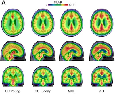 Averaged carbon-11 PBR28 standardized uptake value ratio (SUVR) maps, overlaid on a structural MRI template, suggest a progressively higher uptake in typical Alzheimer's-related regions in the posterior cingulate/precuneus, inferior parietal, and lateral temporal cortices from cognitively unimpaired (CU) young (n = 22) to CU elderly (n = 64), mild cognitive impairment (MCI) (n = 28), and Alzheimer's disease (AD) dementia (n = 16) individuals. Image courtesy of Nature Medicine.