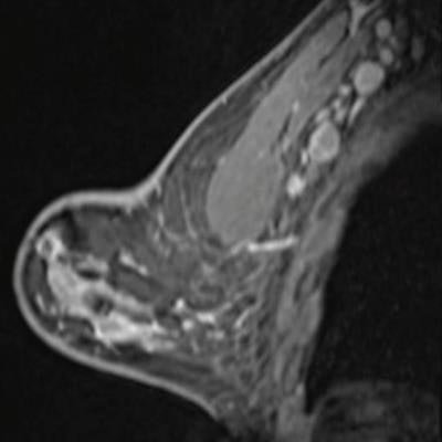 Breast MRI after first COVID-19 vaccination dose. Image courtesy of the American Roentgen Ray Society.