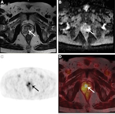 (A) Axial T2-weighted (B) axial apparent diffusion coefficient map, (C) Ga-68 PSMA PET, and (D) fused T2-weighted and Ga-68 PSMA PET/MRI scans in a 64-year-old man with a PI-RADS grade 3 lesion (arrows in A-D) in the right transition zone at multiparametric MRI. Maximum standardized uptake value (SUVmax) in A-D was 4.4. Targeted fusion biopsy diagnosed an International Society of Urological Pathology grade 2 prostate cancer. Image courtesy of Radiology.