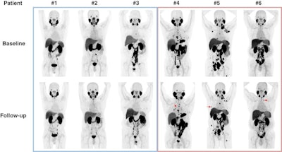 Changes in F-18 DCFPyL-PET/CT imaging after three months of bipolar androgen therapy. Baseline and follow-up maximum intensity projection whole-body images are shown for each patient. For patients 4-6, representative new lesions or sites of progression are indicated by red arrows. Image courtesy of the Journal of Nuclear Medicine.