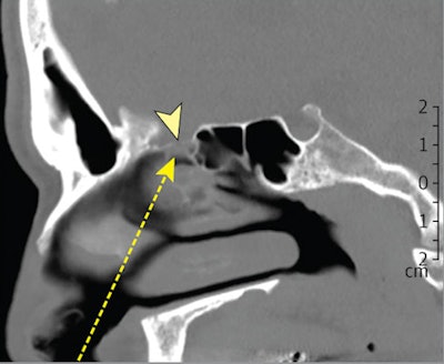 CT scan of a defect in the lamina cribrosa. Image courtesy of JAMA Network.