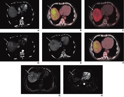 A 74-year-old man with known liver cirrhosis. The patient underwent multiphase contrast-enhanced CT. A lesion in the liver dose (arrow) shows hyperenhancement in the arterial phase (A) and washout in the delayed phase (not shown), consistent with hepatocellular carcinoma. The lesion also shows marked hypermetabolism on FDG-PET/CT (B) but not on F-18 FCH PET/CT (C). The patient underwent multiphase contrast-enhanced CT and FDG-PET/CT one month after radioembolization. The lesion was stable in size and demonstrated persistent hyperenhancement in the arterial phase (D) and washout in the delayed phase (E) but a complete response on FDG-PET/CT (F). The patient underwent MRI six months after the procedure. The lesion shows complete response according to mRECIST, including hyperintensity on unenhanced fat-suppressed T1-weighted imaging (G), without internal enhancement on the subtracted arterial-phase image (H). Image courtesy of the American Journal of Roentgenology.