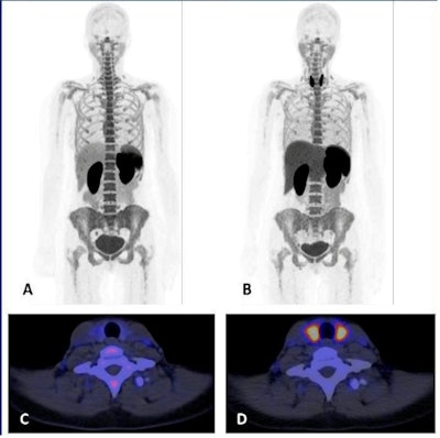 Images A-D show F-18 BMS986192 scans of a patient who developed ICI-related thyroiditis with increased uptake on treatment at six weeks (B,D) compared to baseline (A,C). Image courtesy of the Journal of Nuclear Medicine.