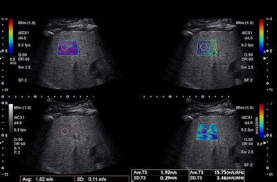 A 60-year-old woman with nonalcoholic fatty liver disease. Liver stiffness one year prior was 5 kPa (1.3 m/s). Image courtesy of Dr. Richard Barr.