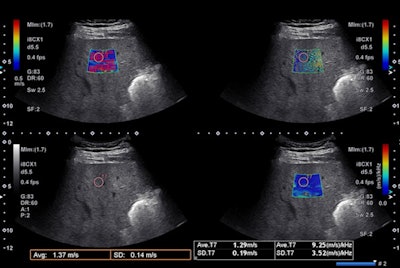 A 63-year-old man with a fatty liver and normal liver enzymes. Image courtesy of Dr. Richard Barr.