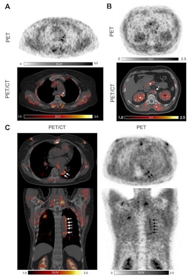 Three examples of Ga-68 FAPI uptake of active arterial segments. All three patients were over 60 years old with a history of hypertension and dyslipidemia. Patients A and C also had diabetes mellitus, and experienced myocardial infarction and percutaneous coronary intervention treatment. Patient A was obese (body mass index = 30) while patient B had a history of heavy smoking.