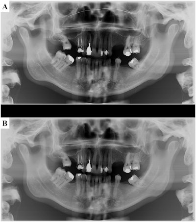 Panoramic radiographs of an anthropomorphic phantom covered with a soft-tissue simulator (Mix-D) acquired with the use of a face mask with a nose wire (A) and with the use of a face mask without nose wire (B). Image courtesy of Academic Radiology.