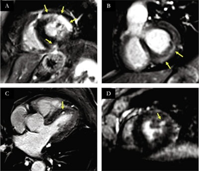 Spectrum of myocardial injuries on reformatted free-breathing high-resolution LGE after COVID-19 infection. Yellow arrows indicate areas with LGE. (A) intramural and subepicardial LGE on the anteriolateral and inferoseptal segments, consistent with myocarditis. (B) subepicardial LGE on inferobasal and infero-latero-basal segments, consistent with myocarditis. (C) focal subendocardial LGE on antero-septal segment consistent with micro-infarction. (D) focal subendocardial LGE on anterolateral segment consistent with microinfarction. Image courtesy of the European Journal of Radiology.