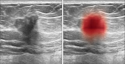 Breast ultrasound images show cancer (at left, as dark spot in center and, at right, in red, as highlighted by AI algorithm). Image courtesy of Nature Communications.