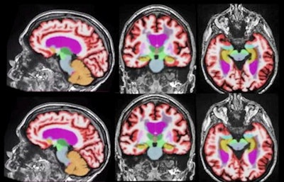 AI-based image reconstruction enables significantly faster brain MRI scan times while maintaining quantification accuracy and enhancing image quality. Representative 3D T1-weighted multiplanar images with volumetric segmentation on a 3-tesla scanner. (Left to right): Sagittal, coronal, and axial T1-weighted images with standard protocols (scan time, 5 minutes and 44 seconds) on the top row and deep learning-enhanced accelerated imaging (scan time, 2 minutes and 18 seconds) on bottom row. Images courtesy of Dr. Suzie Bash.