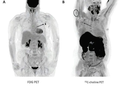 PET imaging showed abnormal radiotracer uptake in the lymph nodes of cancer patients after they received COVID-19 vaccinations. (A) A 57-year-old woman with right upper arm melanoma who received the first dose of the COVID-19 vaccine (Pfizer-BioNTech) in the left deltoid 15 days prior to FDG PET/CT. FDG uptake is observed within left axillary lymph nodes (arrow, SUVmax = 9.3). (B) A 62-year-old man with metastatic prostate carcinoma who received the second dose of COVID-19 vaccine (Pfizer-BioNTech) in the right deltoid seven days prior to C-11 choline PET/CT. Image courtesy of the American Journal of Roentgenology.