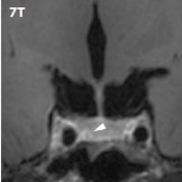 7-tesla MRI showing pituitary lesions. Image courtesy of Dr. Jeroen Hendrikse.