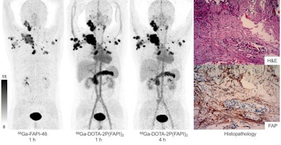 Ga-68 FAPI-46, one hour after injection, and Ga-68 DOTA-2P (FAPI)2, one and four hours after injection, in a patient with metastatic thyroid cancer. Hematoxylin and eosin (H&E) staining and FAP immunohistochemistry staining showed high FAP expression in the tumor stroma (original magnification, ×100). Image courtesy of the Journal of Nuclear Medicine.