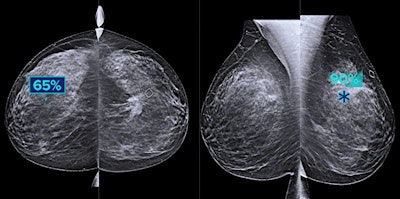 Hologic's Genius AI software highlights suspicious areas of interest on breast tomosynthesis exams. Image courtesy of Hologic.