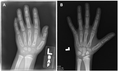 Sample examinations in the study. (A) Computed radiograph in a girl randomly assigned to the control group at center 2 with low AI error and high radiologist error (AI = 46 months, chronologic age = 76 months, radiologist = 69 months, panel = 41 months). (B) Computed radiograph in a boy randomly assigned to the control group at center 4 with high AI error and low radiologist error (AI = 126 months, chronologic age = 140 months, radiologist = 105 months, panel = 100.5 months). Images and caption courtesy of the RSNA.