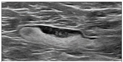 A 55-year-old woman who underwent screening mammogram and ultrasound seven days after her first COVID-19 vaccination dose. Screening mammogram and ultrasound demonstrated unilateral left axillary lymph node with cortical thickness of 5 mm on ultrasound (not shown). BI-RADS category 0 was assigned. Ultrasound from diagnostic workup performed seven days later showed no change in lymph node size. BI-RADS 3 was assigned.