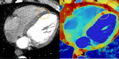 Myocardial perfusion defects are difficult to visualize on conventional CT (left) due to beam-hardening artifacts, but they are visible on spectral CT (right). Image courtesy of Philips Healthcare.
