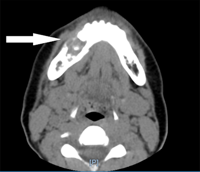 A CT scan without contrast shows a lytic lesion of the right mandible.