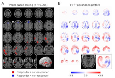 Statistical maps of hyperperfusion (red) and hypoperfusion (blue) obtained by conventional univariate voxel-based one-sided t-tests corrected for injection latency, thresholded at p = 0.005 and overlaid on the statistical parametric mapping single subject template (A). Part B shows the 'favorable ictal perfusion pattern.' (I/C = ipsilateral/contralateral to temporal lobe epilepsy surgery). Image courtesy of the Journal of Nuclear Medicine.