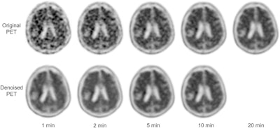 Visual comparison of reduced scan time PET images before and after denoising by MCDNet-2, with those of the normal scanning time of 20 minutes.