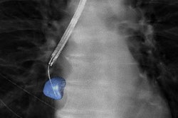 2021 10 06 23 15 8828 2021 10 07 3 D Lung Biopsy 20211006234252