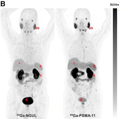 Representative image showing normal-organ distribution of Ga-68 PSMA-11 and Ga-68 NGUL. B = bladder; K = kidney; L = liver; S = spleen; SG = salivary glands; SUVbw = SUV body weight. Image courtesy of the Journal of Nuclear Medicine.