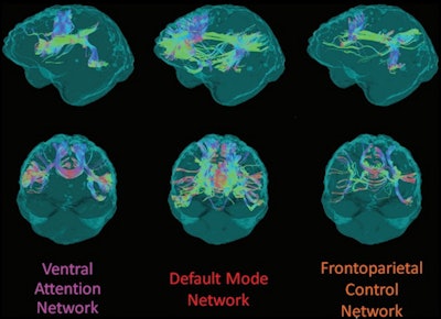 Example of structural connectivity of the three analyzed distributed cortical networks from one participant in the DIAN cohort, viewed laterally from the left (top row) and anteriorly (bottom row). Streamline colors indicate directionality of water diffusion at diffusion tensor imaging: green = anteroposterior, red = left-right, blue = superoinferior. Images and caption courtesy of the RSNA.