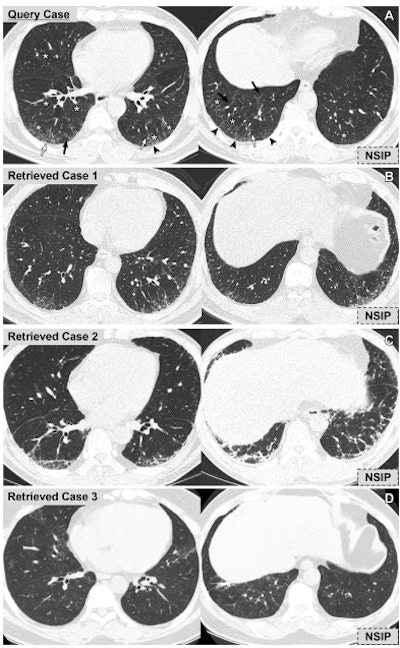 Representative case of the use of content-based image retrieval (CBIR) system for diagnosis of interstitial lung disease (ILD). (A) Query CT scans (noncontrast axial chest CT scans in a 62-year-old man) show reticulation (arrowheads), traction bronchiectasis (white arrows), interlobular septal thickening (black arrows), and peribronchovascular ground-glass opacity (*) involving both mid to lower lung zones. (B-D) The CBIR system retrieved all three similar cases with the diagnosis of nonspecific interstitial pneumonia (NSIP). The query case was diagnosed as NSIP. For four readers, including two radiology residents, one nonradiology physician, and one board-certified radiologist, the diagnosis was incorrect and rated as smoking-related ILD or chronic hypersensitivity pneumonitis at the first review session (before CBIR); however, the diagnosis was correct at the second session after the use of the CBIR system. For the other four readers including two radiologists and two nonradiology physicians, the diagnoses were correct in both sessions and the confidence levels were improved (intermediate to high) in two radiologists and one nonradiology physician after applying the CBIR system. Images and caption courtesy of the RSNA.